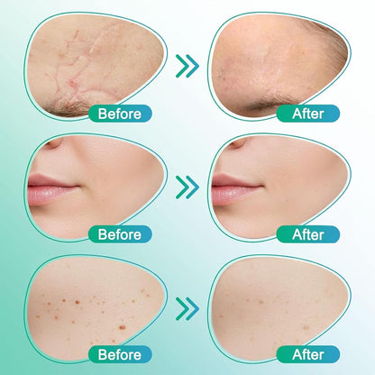 3-in-1 Microneedle Treatment Patch